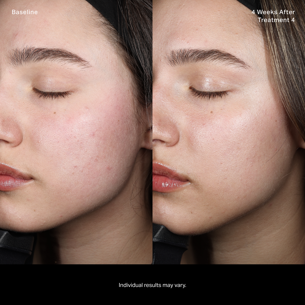 HydraClear™ Treatment Booster