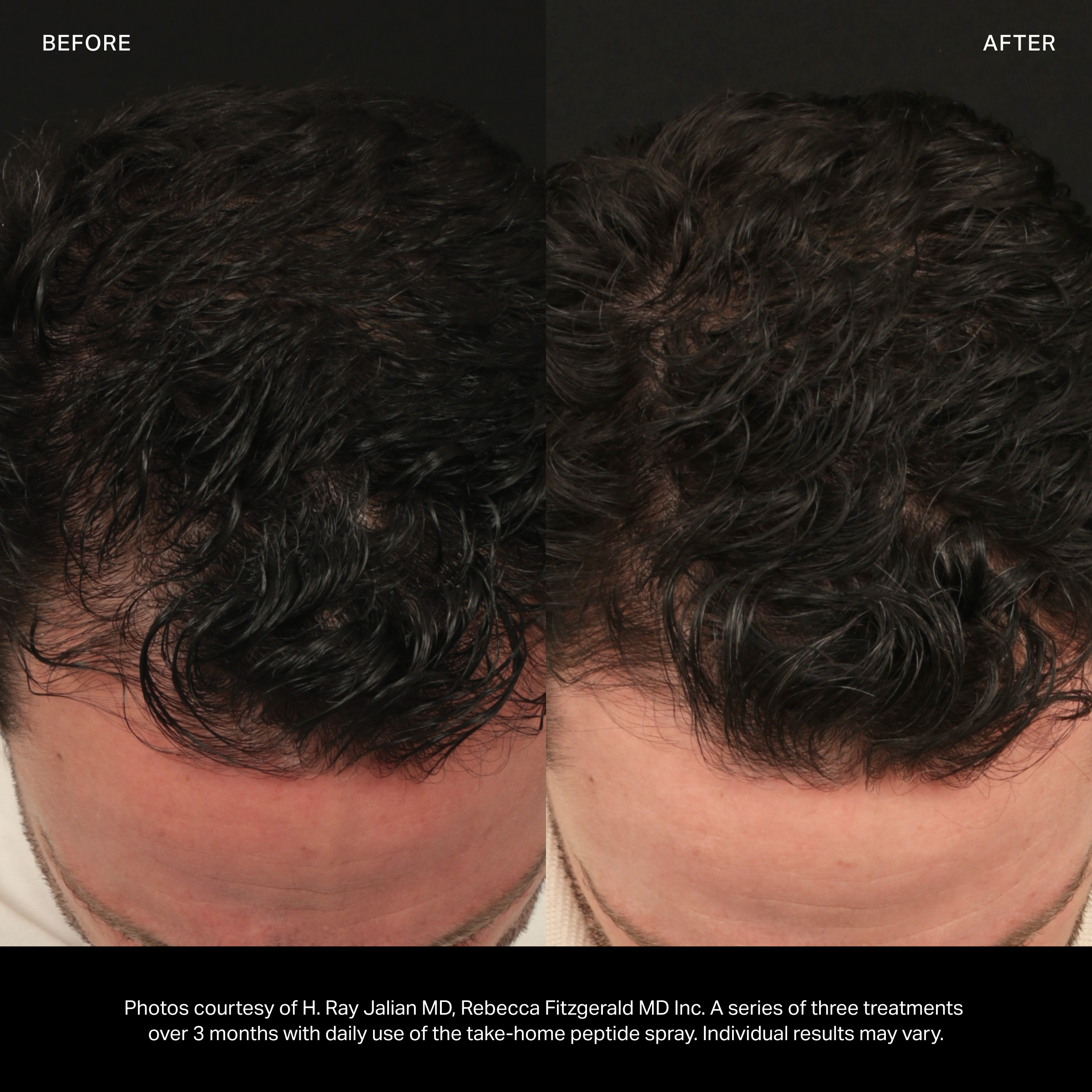 HydraScalp with Keravive™ Booster